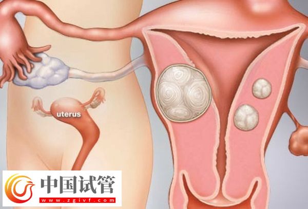 没有子宫能生孩子吗(图1) 没有子宫能生孩子吗(图1)