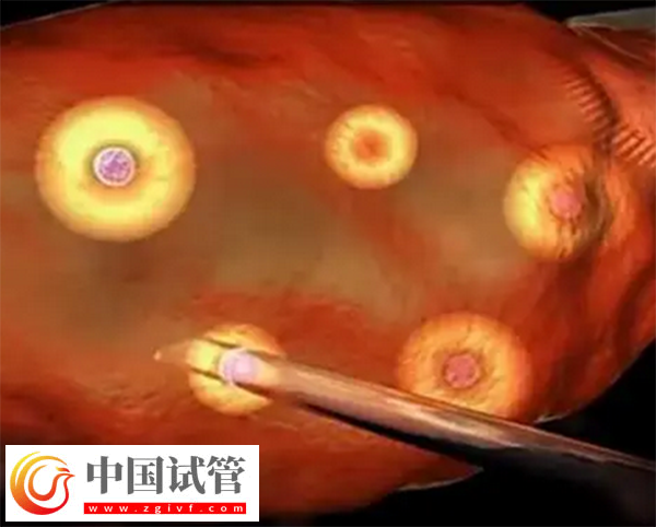 前往长沙做三代试管生孩子多少钱(图3)