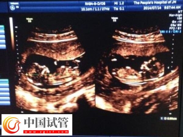 做试管怀双胞胎减胎有没有风险(图2) 做试管怀双胞胎减胎有没有风险(图1)