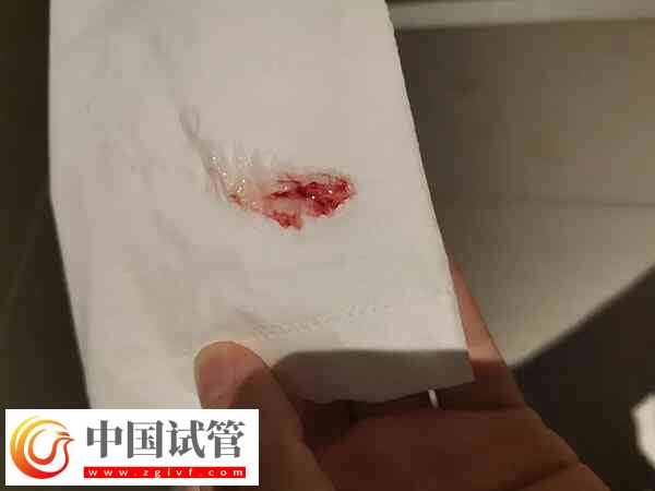 试管移植后有褐色血是不是生化了(图1)