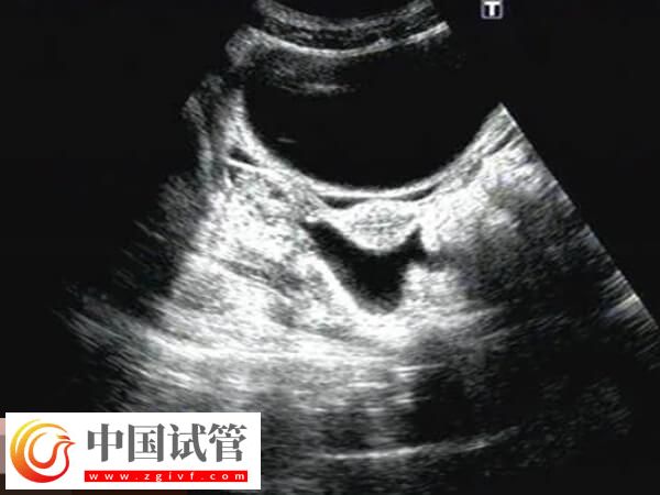 鲜胚移植后宫腔积液要注意，多久才能吸收一看便知(图1)
