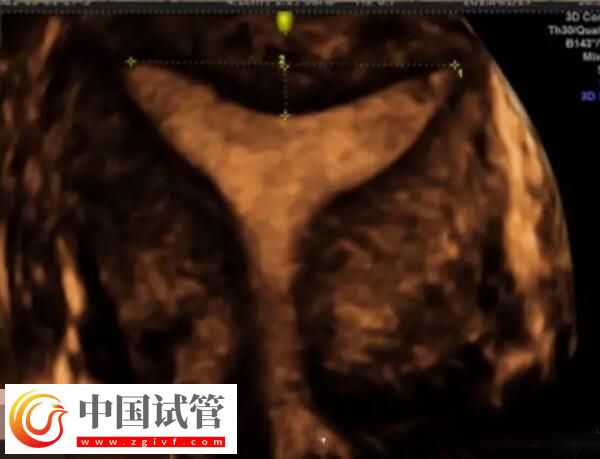 鲜胚移植后宫腔积液要注意，多久才能吸收一看便知(图2)