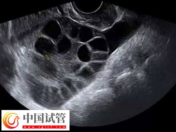 试管取卵对女性的卵泡也有要求，小于18mm一般还未发育成熟(图1)