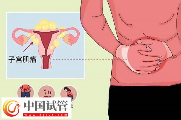 子宫肌瘤是什么原因导致的?专家解读子宫肌瘤的原因(图1) 子宫肌瘤是什么原因导致的?专家解读子宫肌瘤的原因(图1)